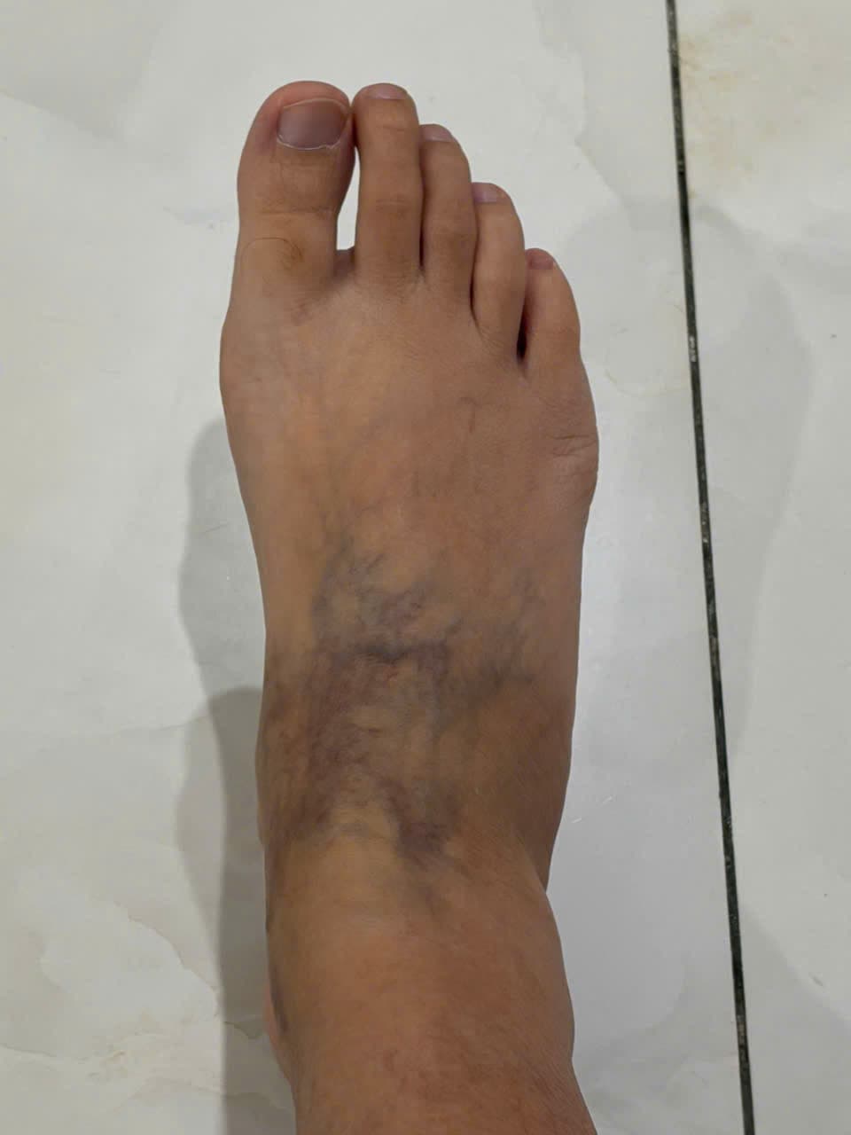 Ngoc Huynh varicose veins before Vista Care